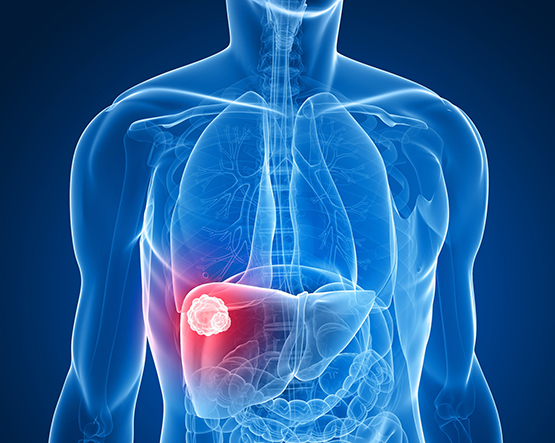 liver cancer