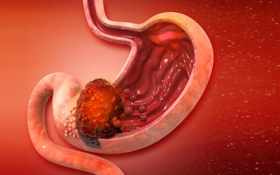 What is the Survival Rate for Stomach Cancer (Gastric)?