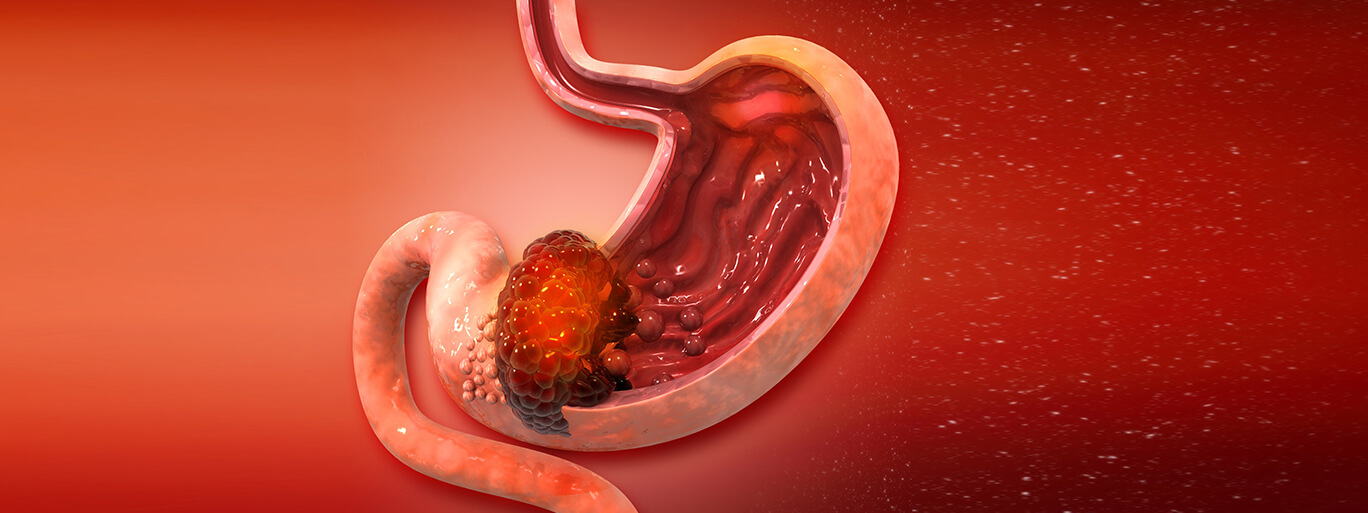 What is the Survival Rate for Stomach Cancer