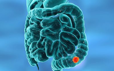 Why is colorectal cancer incidence rising in the young