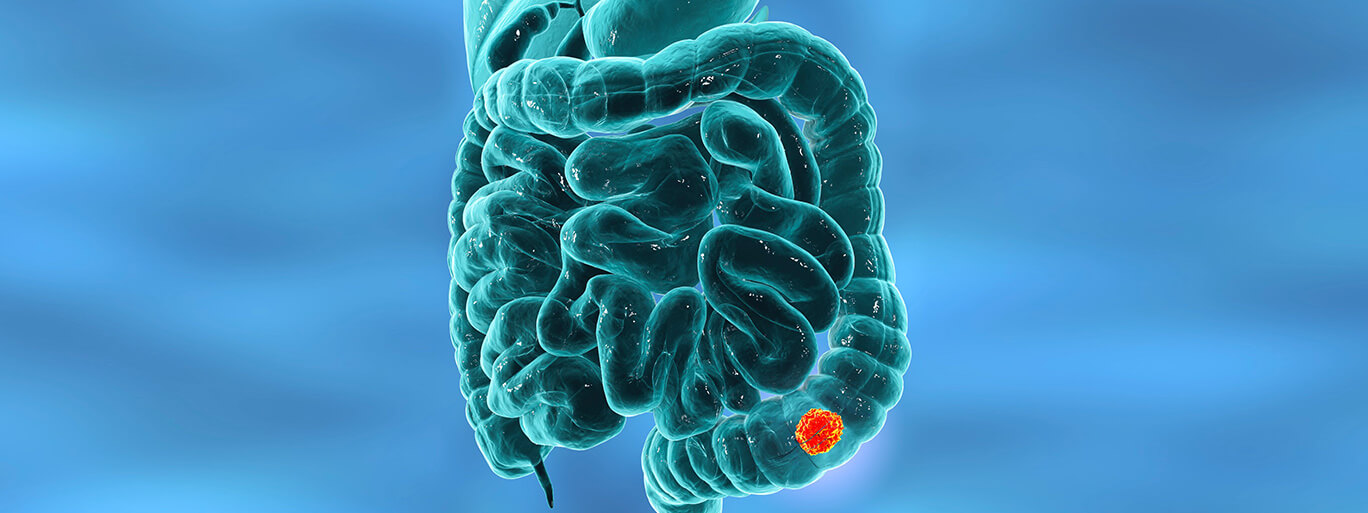 why is colorectal cancer incidence rising in the young