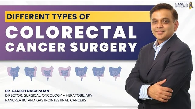 Colorectal Cancer Surgery: Types & Techniques – Dr. Ganesh Nagrajan