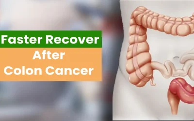 How to Recover Faster After Colon Cancer Surgery