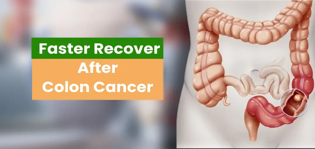 How to Recover Faster After Colon Cancer Surgery