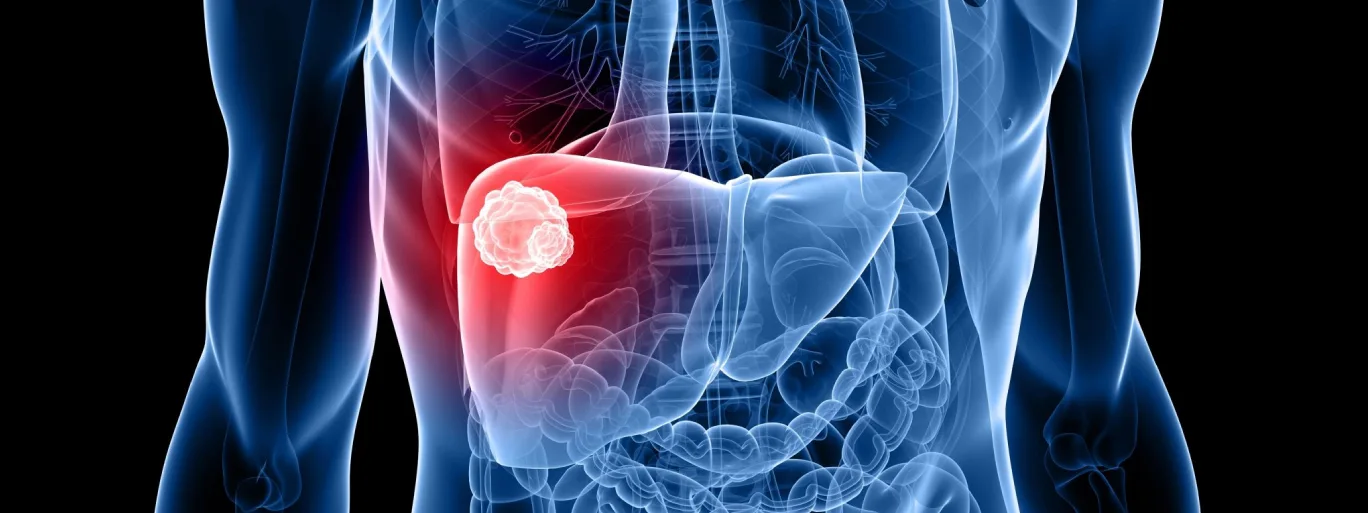 Causes and Symptoms of Liver Cancer