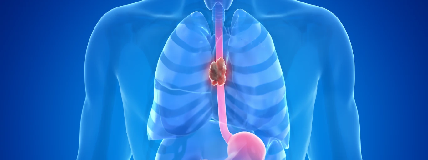 Top Treatment Options for Esophageal Cancer