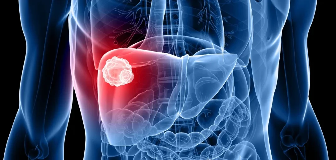 Causes and Symptoms of Liver Cancer