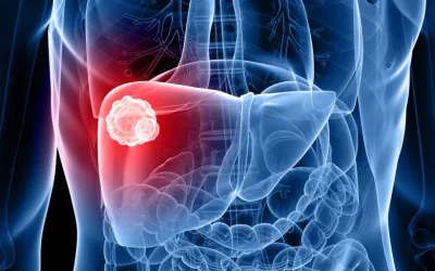 Causes and Symptoms of Liver Cancer