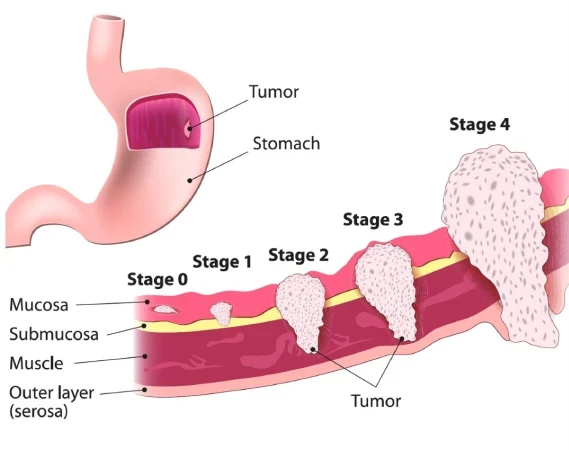 Stages of cancers