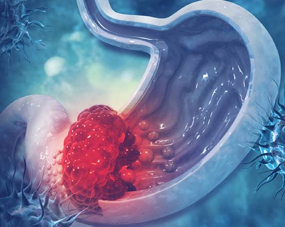 Gall Bladder Cancer Treatment in Mumbai